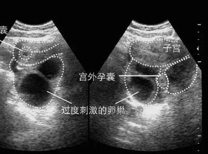 女人月经后几天可以做泰国试管？